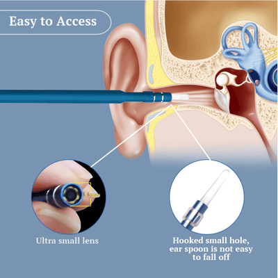 Endoscopic Ear Cleaning Tool With Live Imaging Support