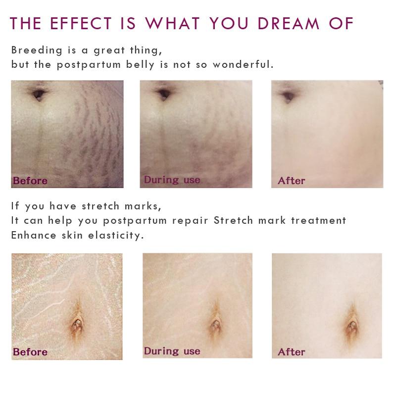 Natural Pregnancy Stretch Mark Removal Cream
