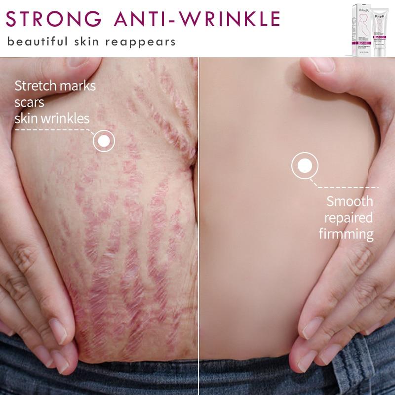 Natural Pregnancy Stretch Mark Removal Cream
